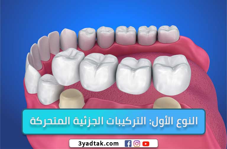 النوع الأول: التركيبات الجزئية المتحركة