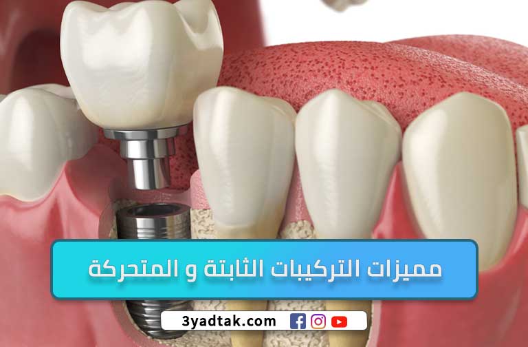 انواع الاسنان التركيب (الأسنان الثابتة، الأسنان المتحركة)