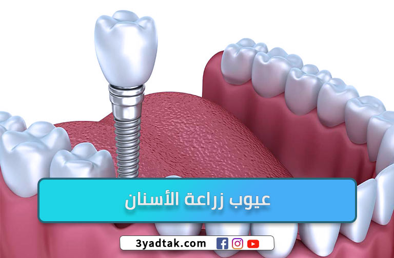 تعرف على مشاكل زراعة الأسنان و 6 العيوب لزراعة الأسنان