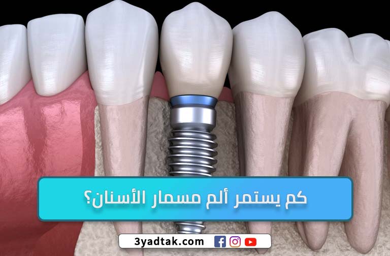 تعرف على مشاكل زراعة الأسنان و 6 العيوب لزراعة الأسنان