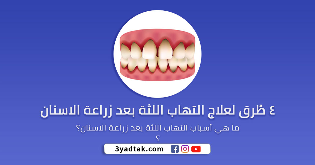 4 طُرق لعلاج التهاب اللثة بعد زراعة الاسنان وأسباب الإلتهاب