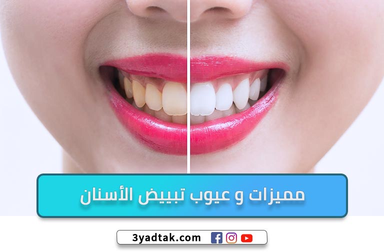 6 أنواع تبييض الأسنان وعيوب ومميزات تبييض الأسنان