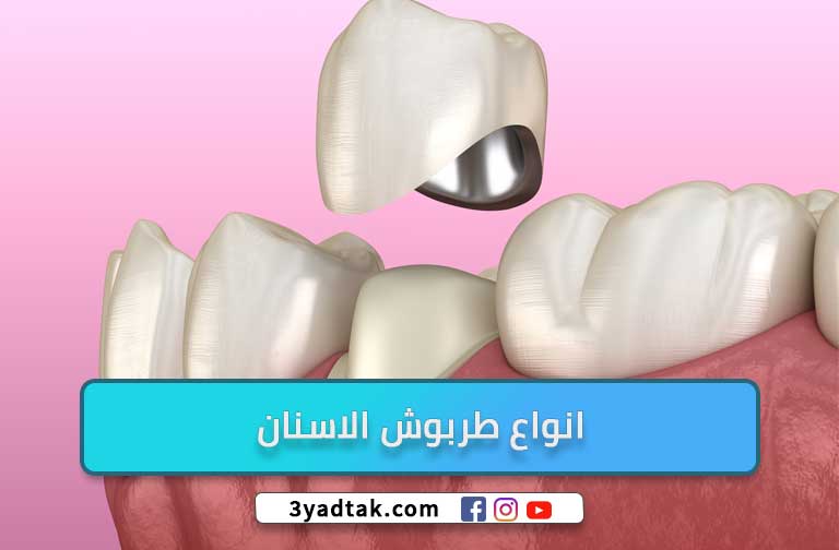 أشهر 5 انواع طربوش الاسنان واهم مميزاته وعيوبه و تكلفته