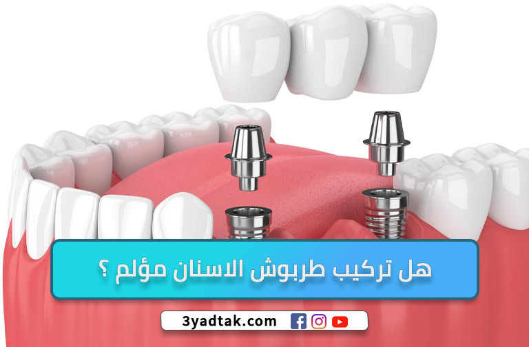 أشهر 5 انواع طربوش الاسنان واهم مميزاته وعيوبه و تكلفته