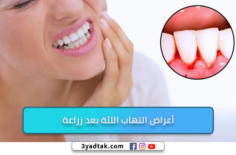 4 طُرق لعلاج التهاب اللثة بعد زراعة الاسنان وأسباب الإلتهاب