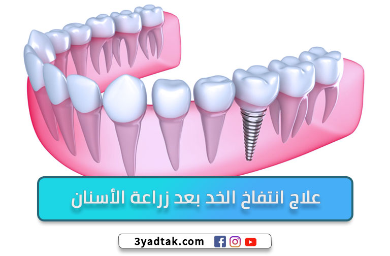 اسباب انتفاخ الخد بعد زراعة الأسنان وأهم 4 حالات تستدعي الطب