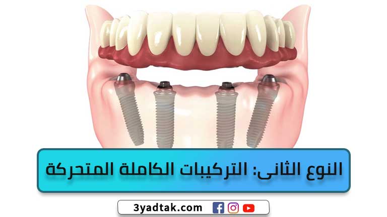 التركيبات الكاملة المتحركة