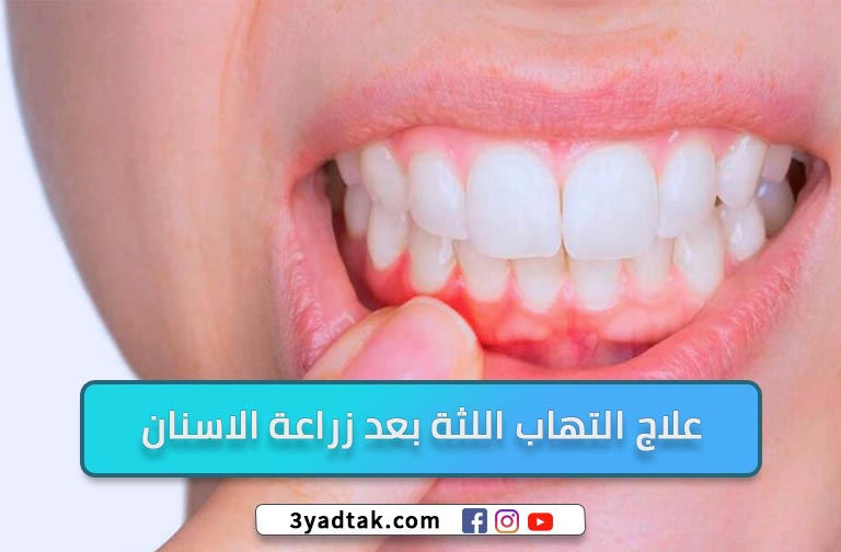 4 طُرق لعلاج التهاب اللثة بعد زراعة الاسنان وأسباب الإلتهاب