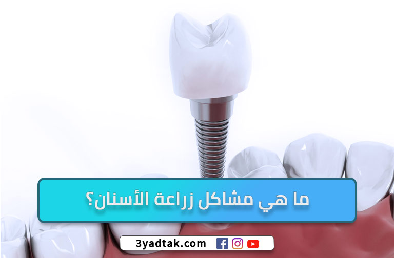 تعرف على مشاكل زراعة الأسنان و 6 العيوب لزراعة الأسنان