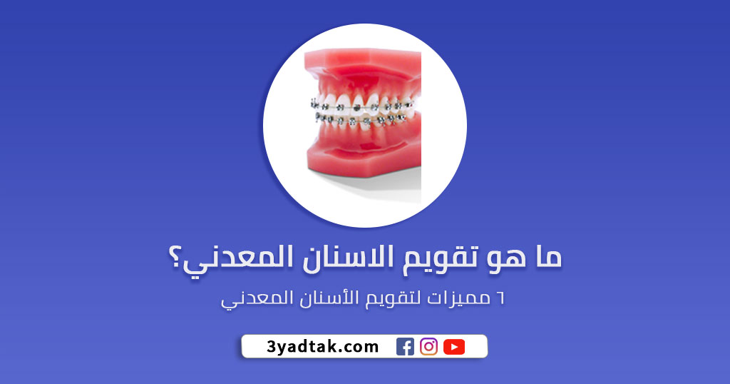 تقويم الاسنان المعدني و 6 ميزات لتقويم الأسنان المعدني