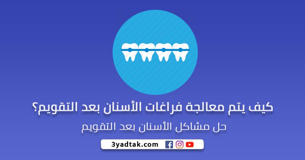 فراغات الاسنان بعد التقويم