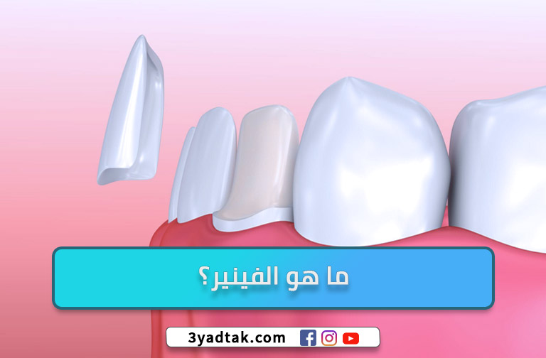 ما هو الفينير ؟ أهم 5 استخدامات طبيه وتجميليه للفينير