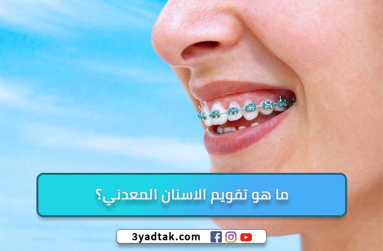 ما هو تقويم الاسنان المعدني؟