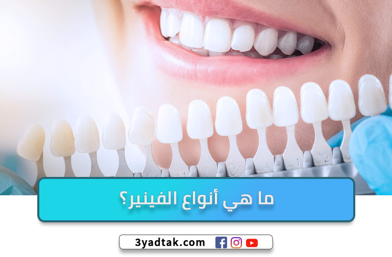 ما هي أنواع الفينير؟