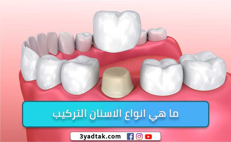 انواع الاسنان التركيب (الأسنان الثابتة، الأسنان المتحركة)