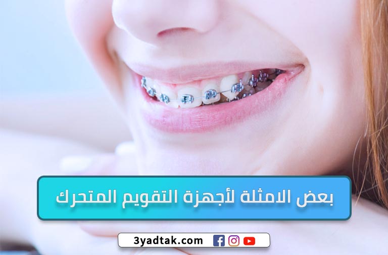 معلومات عن تقويم الاسنان وأهم 5 فوائد لتقويم الأسنان