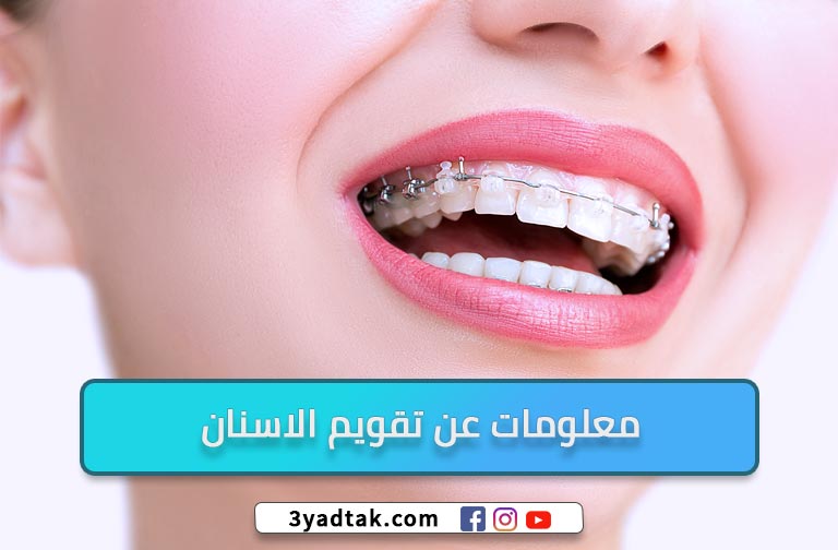 معلومات عن تقويم الاسنان وأهم 5 فوائد لتقويم الأسنان