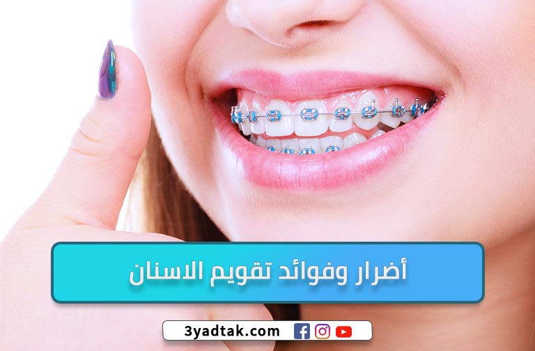 معلومات عن تقويم الاسنان وأهم 5 فوائد لتقويم الأسنان