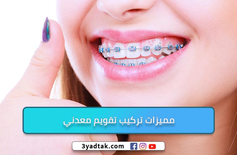 تقويم الاسنان المعدني و 6 ميزات لتقويم الأسنان المعدني