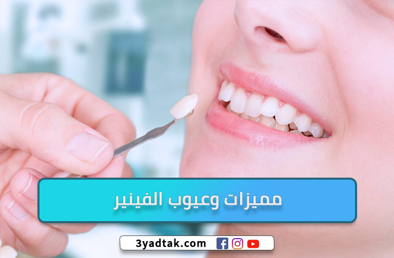 مميزات وعيوب الفينير