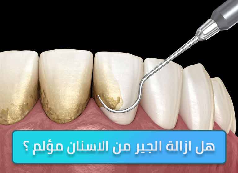 هل ازالة الجير من الاسنان مؤلم ؟ 1