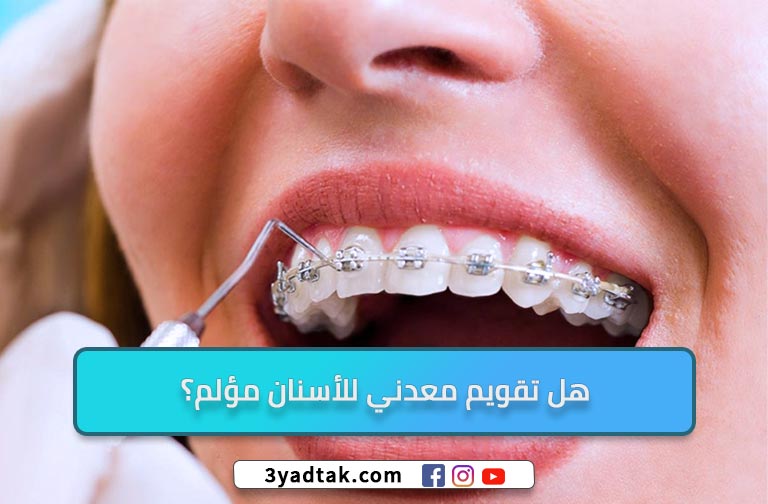 تقويم الاسنان المعدني و 6 ميزات لتقويم الأسنان المعدني