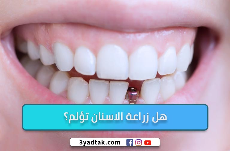 هل يوجد ألم بعد زراعة الأسنان؟ مميزات ومضاعفات زراعة الأسنان