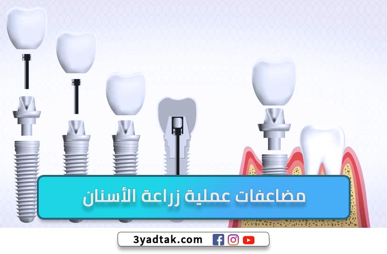 هل يوجد ألم بعد زراعة الأسنان؟ مميزات ومضاعفات زراعة الأسنان