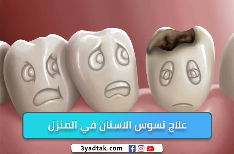 علاج تسوس الاسنان في المنزل