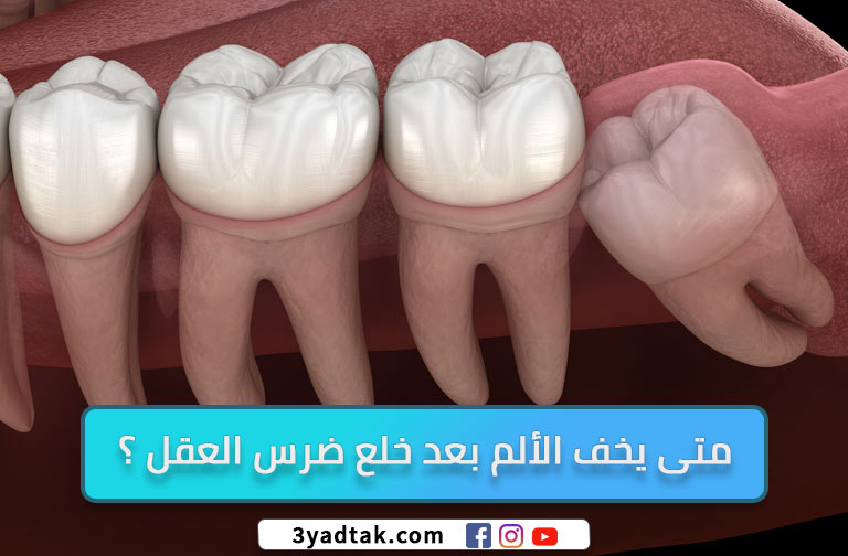 متى يخف الألم بعد خلع ضرس العقل